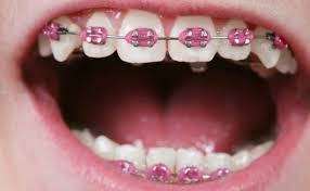 Ortho Bracket Pink